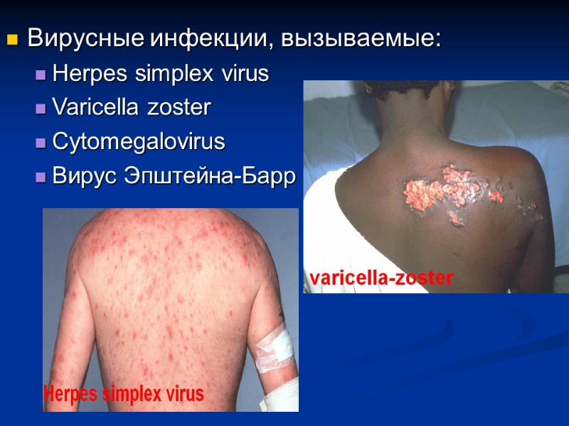 Вирусные инфекции, вызываемые: Herpes simplex virus Varicella zoster  Cytomegalovirus Вирус Эпштейна-Барр